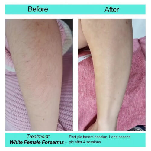 Before and After picture White Female Forearms
